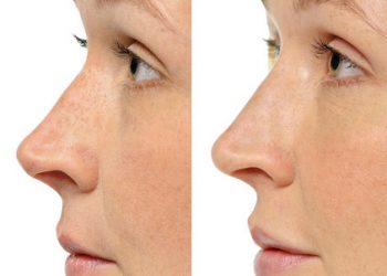 Wrinkle Correction Injections – Before and After