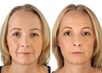 Wrinkle Correction Injections – Before and After