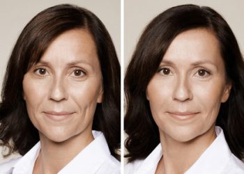 Wrinkle Correction Injections – Before and After