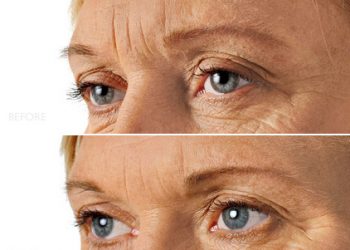 Wrinkle Correction Injections – Before and After