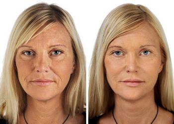 Wrinkle Correction Injections – Before and After