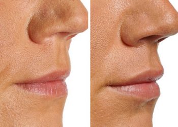 Wrinkle Correction Injections – Before and After