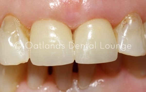 After - Oatlands Dental Lounge