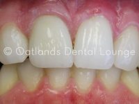 After - Oatlands Dental Lounge