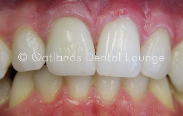 After - Oatlands Dental Lounge