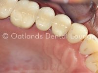After - Oatlands Dental Lounge