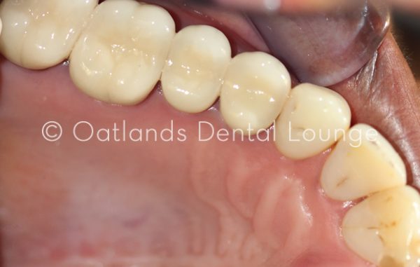 After - Oatlands Dental Lounge