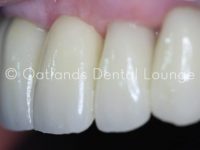 After - Oatlands Dental Lounge