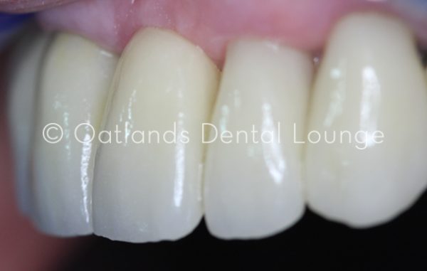 After - Oatlands Dental Lounge