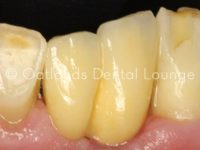After - Oatlands Dental Lounge