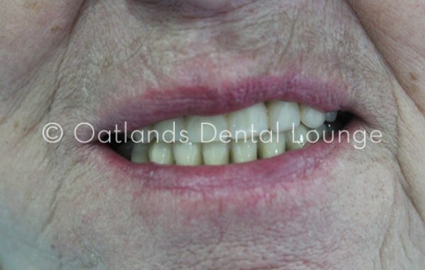After - Oatlands Dental Lounge