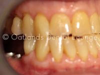 After - Oatlands Dental Lounge