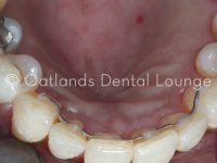 After - Oatlands Dental Lounge