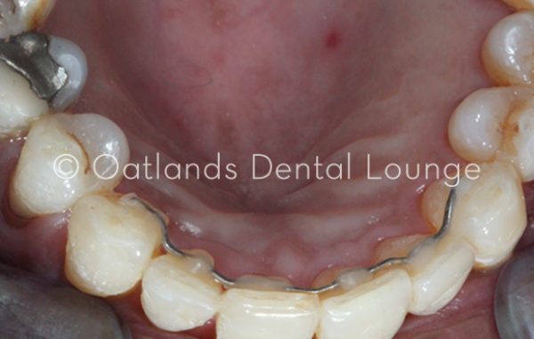 After - Oatlands Dental Lounge