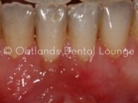 After - Oatlands Dental Lounge