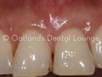 After - Oatlands Dental Lounge