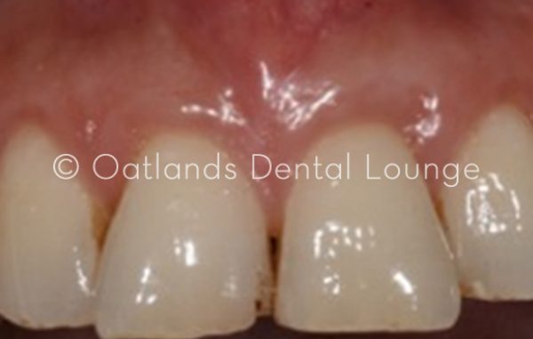 After - Oatlands Dental Lounge