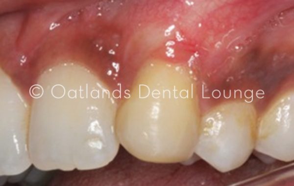 After - Oatlands Dental Lounge