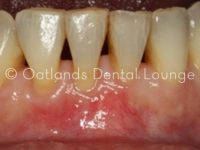 After - Oatlands Dental Lounge