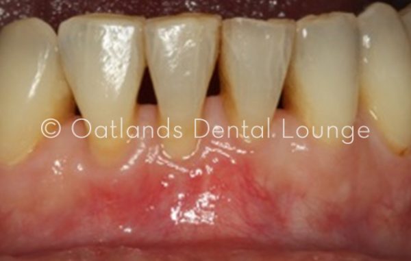After - Oatlands Dental Lounge