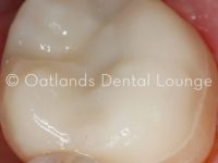 After - Oatlands Dental Lounge