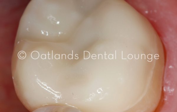 After - Oatlands Dental Lounge