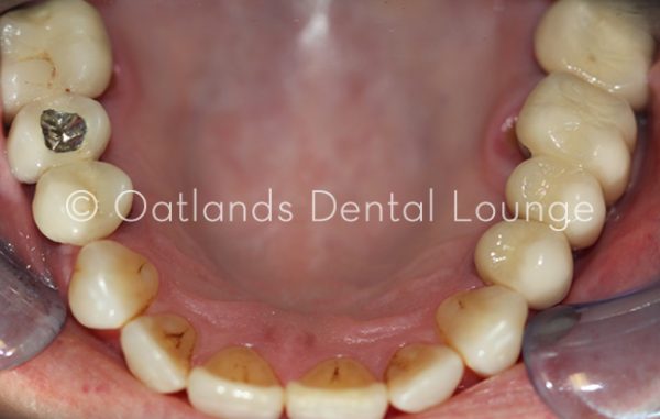 After - Oatlands Dental Lounge