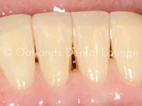 After - Oatlands Dental Lounge