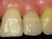 After - Oatlands Dental Lounge
