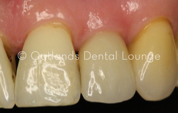 After - Oatlands Dental Lounge
