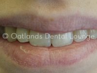 After - Oatlands Dental Lounge