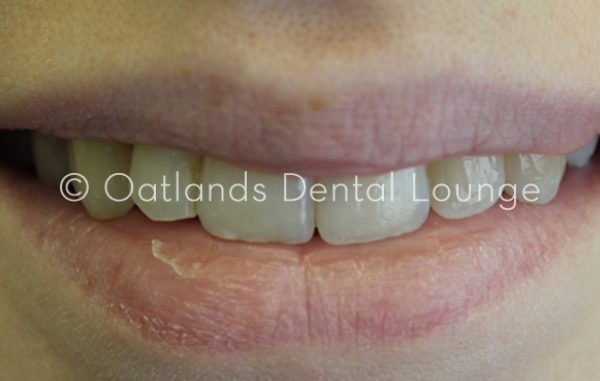 After - Oatlands Dental Lounge