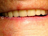 After - Oatlands Dental Lounge