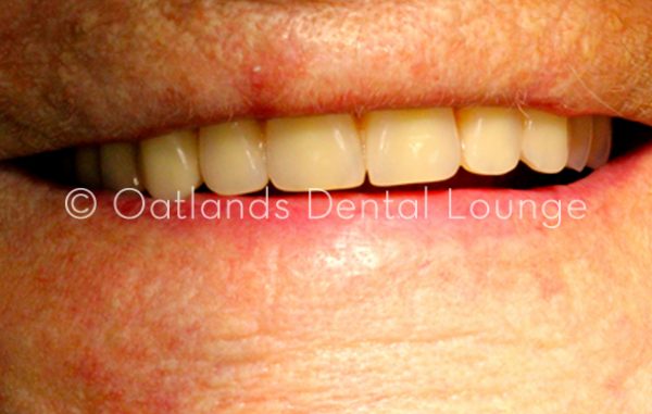 After - Oatlands Dental Lounge