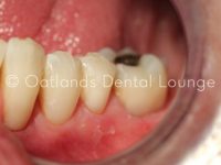 After - Oatlands Dental Lounge
