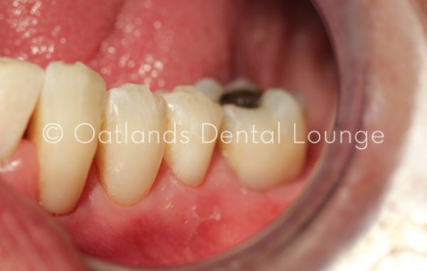 After - Oatlands Dental Lounge