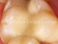 After - Oatlands Dental Lounge