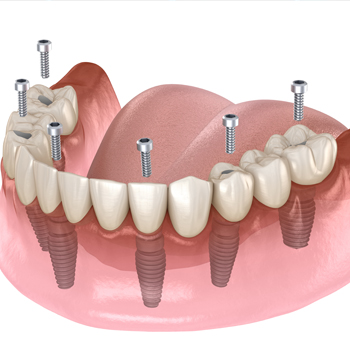 Treatment - Oatlands Dental Lounge