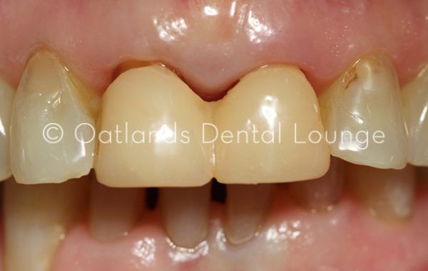 Before - Oatlands Dental Lounge