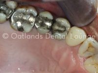 Before - Oatlands Dental Lounge