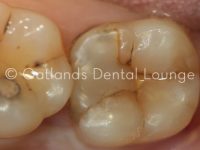 Before - Oatlands Dental Lounge