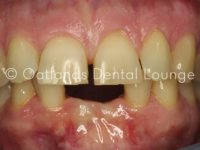 Before - Oatlands Dental Lounge