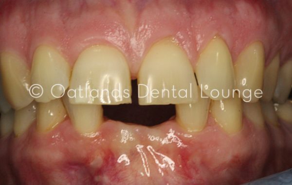 Before - Oatlands Dental Lounge