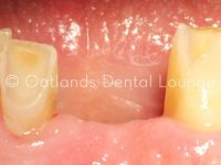 Before - Oatlands Dental Lounge