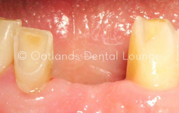 Before - Oatlands Dental Lounge