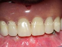 Before - Oatlands Dental Lounge