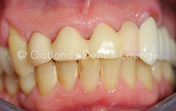 Before - Oatlands Dental Lounge
