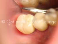 Before - Oatlands Dental Lounge