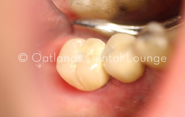Before - Oatlands Dental Lounge