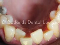 Before - Oatlands Dental Lounge